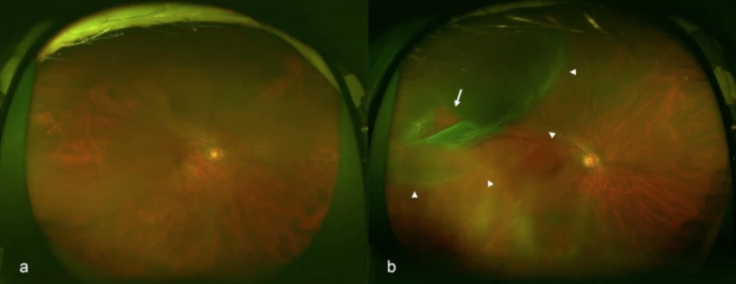 Representative fundus images obtained by ultra wide field scanning laser ophthalmoscopy. Ultra wide field right fundus images without rhegmatogenous retinal detachment (RRD) (a) and with RRD (b). The arrow indicates the retinal break and the arrowheads indicate the areas of RRD.